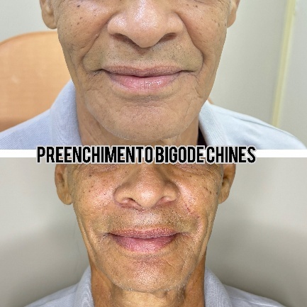 Preenchimento de bigode chinês