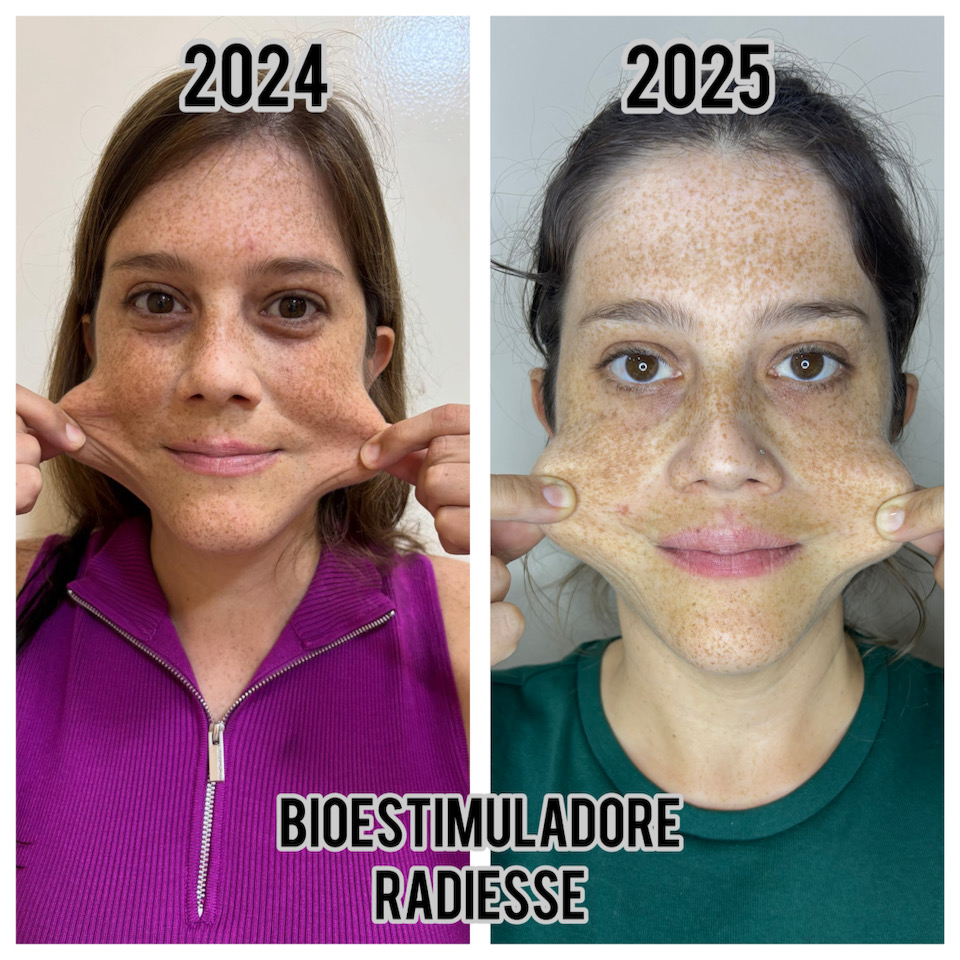 Bioestimulador de colágeno