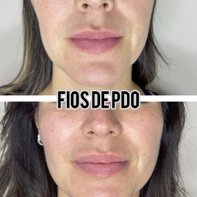Fios de PDO no terço inferior
