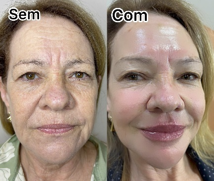 Harmonização facial completa