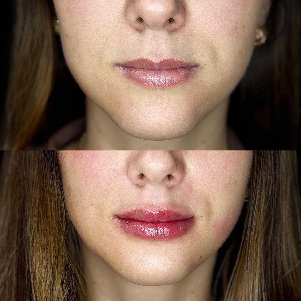 Preenchimento labial