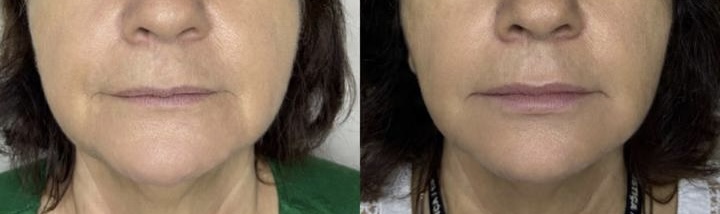 Harmonização labial
